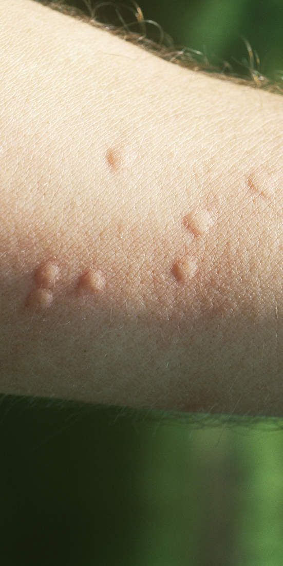 Understanding Skin Reactions: Causes, Symptoms, And Treatment Options 